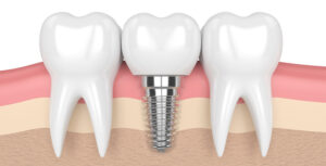Knowing Your Tooth Replacement Options