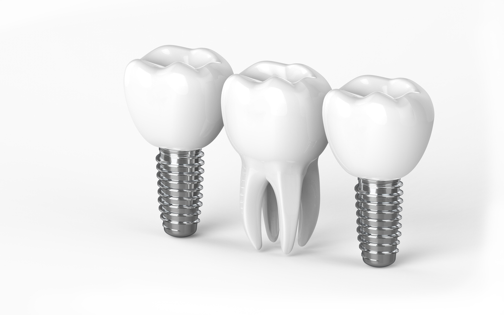 Knowing Your Tooth Replacement Options - Smile Today Dentistry