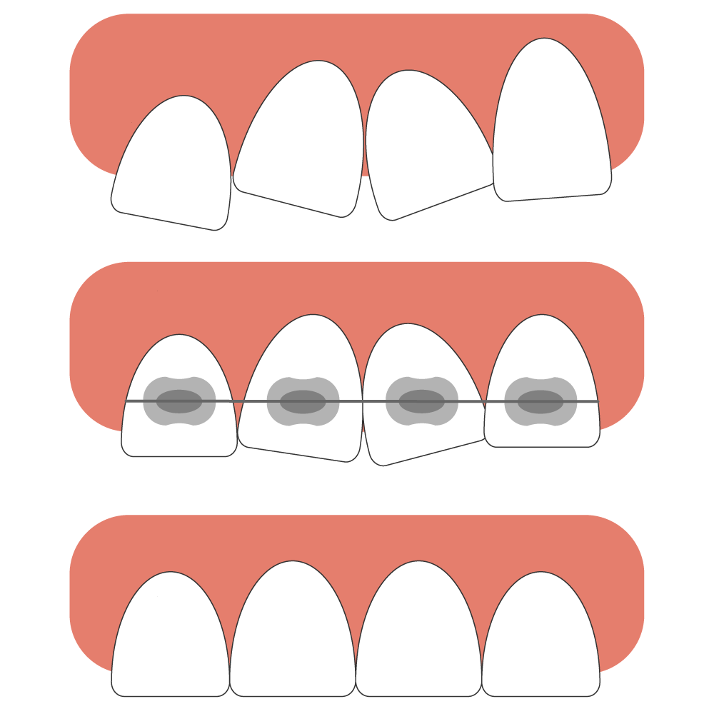 The Importance of Straightening Your Teeth